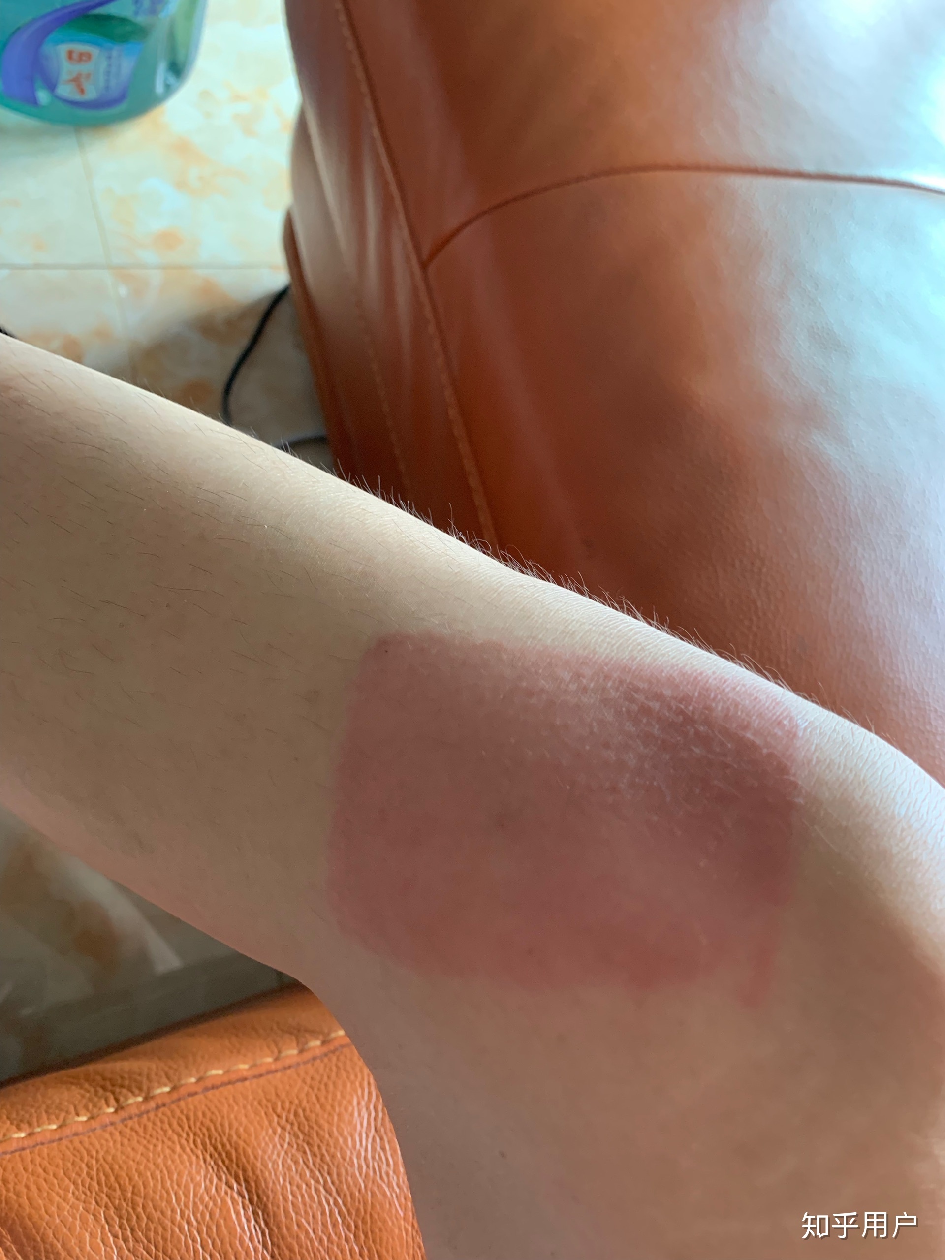 2、貼膏藥的地方有很多紅疙瘩，好不好？